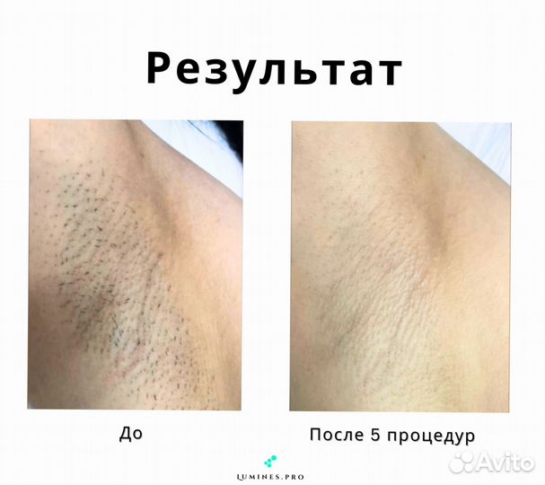 Диодный лазер люминес Макс Ван 1200W