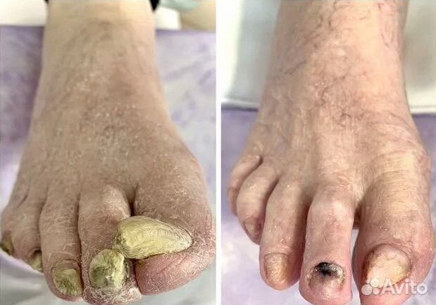 Лечение ногтей на ногах, подолог