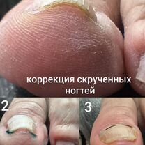Подологический педикюр, Зеленоград