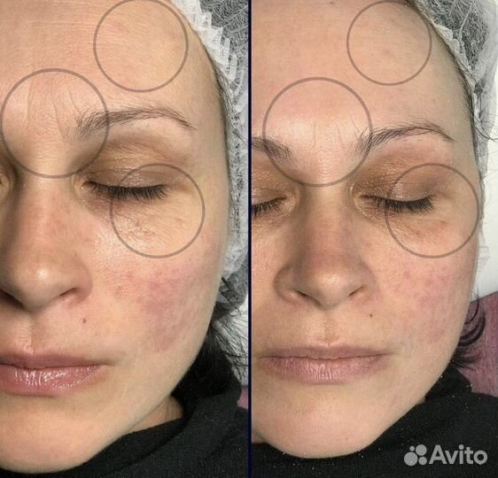 Массаж лица