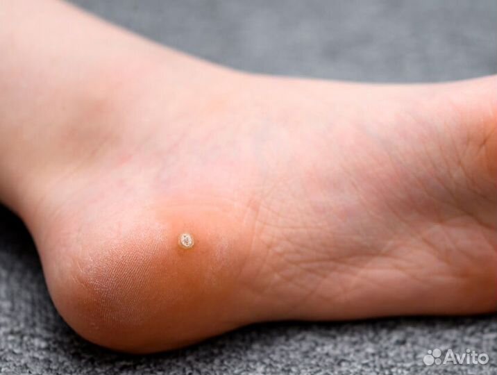 Удаление бородавок