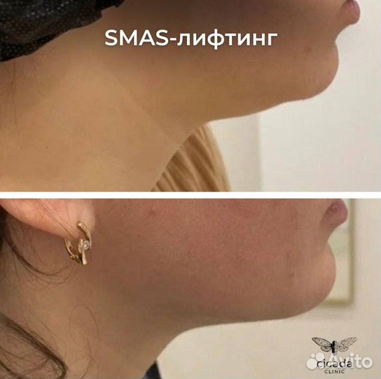 Smas лифтинг