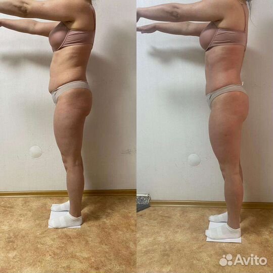 Липопластика тела (ручная коррекция фигуры)