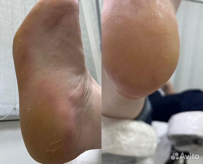 Подолог, педикюр