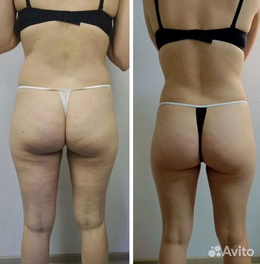 Антицеллюлитный массаж