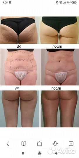 Кавитация, RF, вакуум