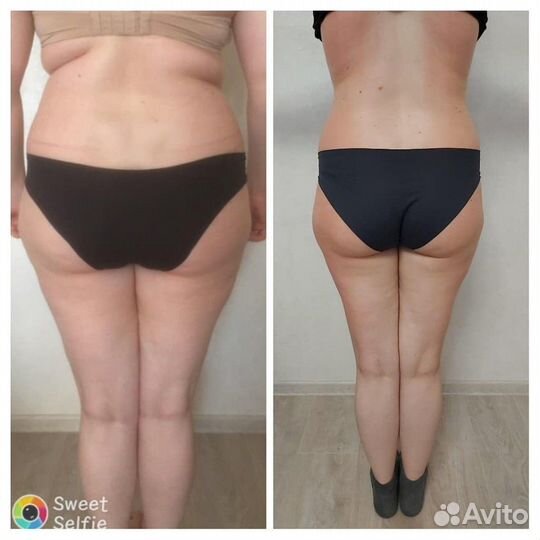 Кавитация#, RF Лифтинг, LPG, Горячий вакуум