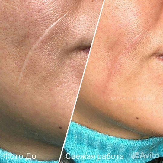 Реконструктивная дермопигментация