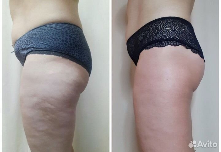 Антицеллюлитный Массаж