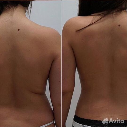 Кавитация#, RF Лифтинг, LPG, Горячий вакуум