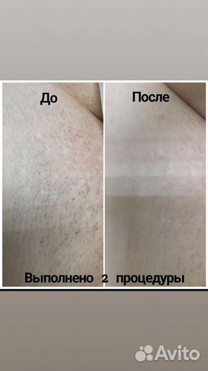 Лазерная эпиляция