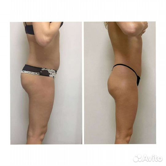 Кавитация, вибро массаж, LPG массаж