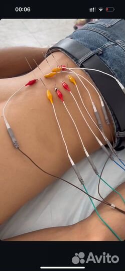 Спортивный массаж+иглоукалывание