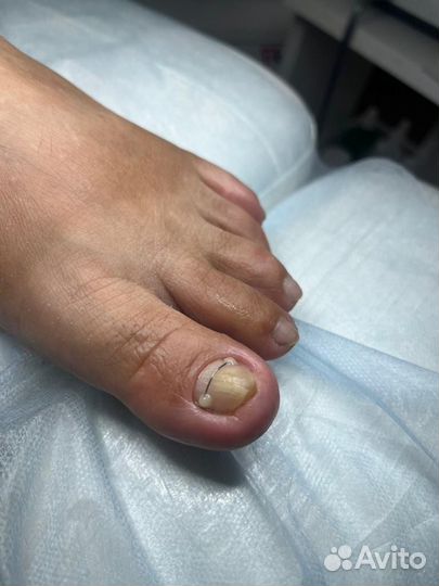 Установка титановой нити