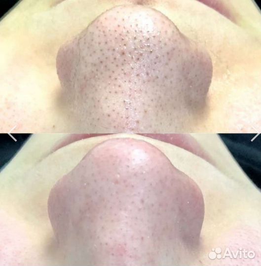 Косметолог чистка лица