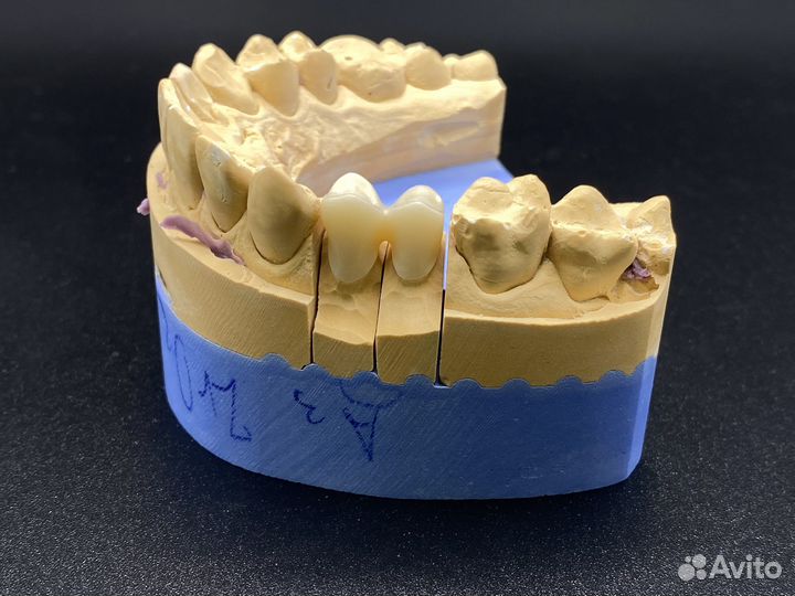 Изготовление анатомической коронки из 3D диоксид ц