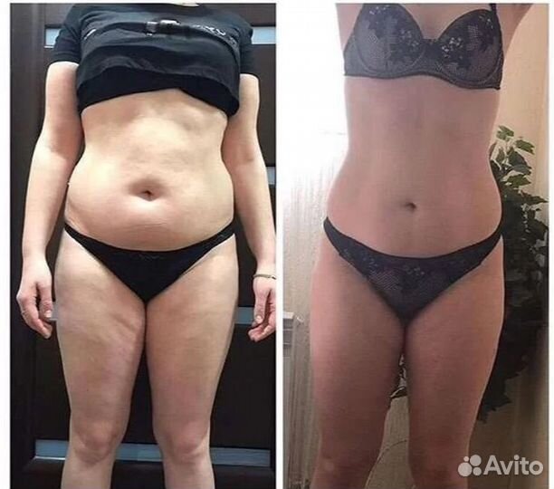 Плоский живот - размер за 1 процедуру в Перми