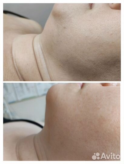 Массаж.Естественное омоложение без инъекций