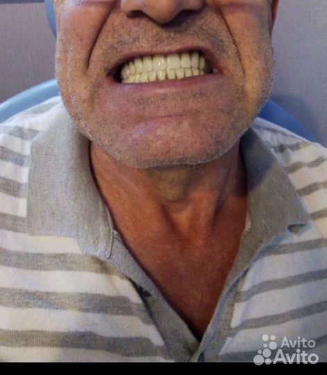 Зубные протезы