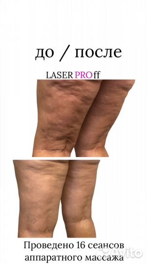 Антицеллюлитный аппаратный массаж