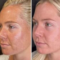 Пилинг лица/ желтый пилинг/ мезопилинг