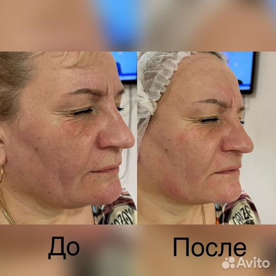 Smas лифтинг лица(подтяжка)