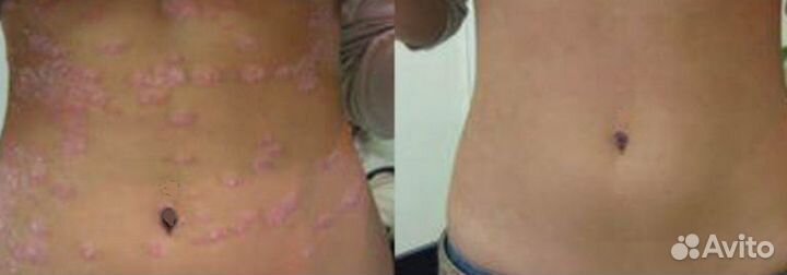 Псориаз профилактика