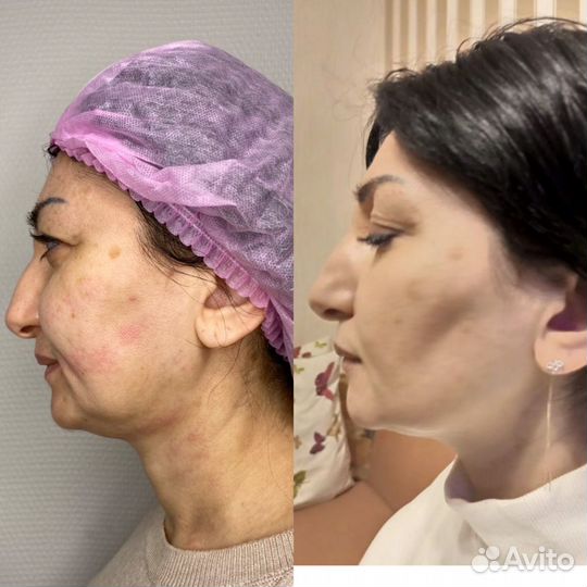 Модель SMAS lifting