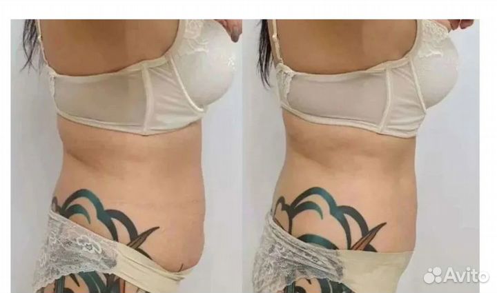 Похудение для мужчин и женщин Криолиполиз Кирове