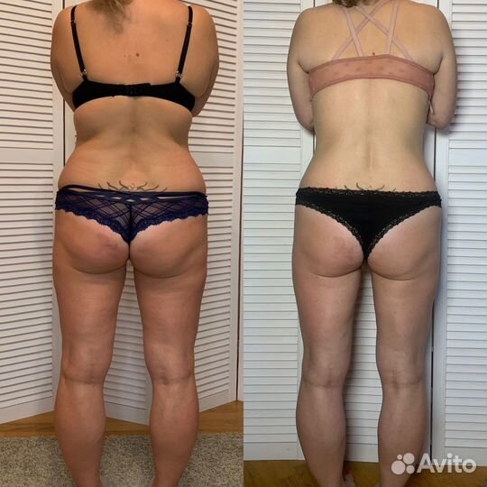 Антицеллюлитный массаж,Коррекция фигуры