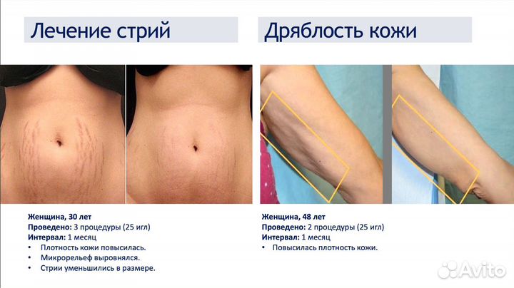 Микроигольчатый RF лифтинг