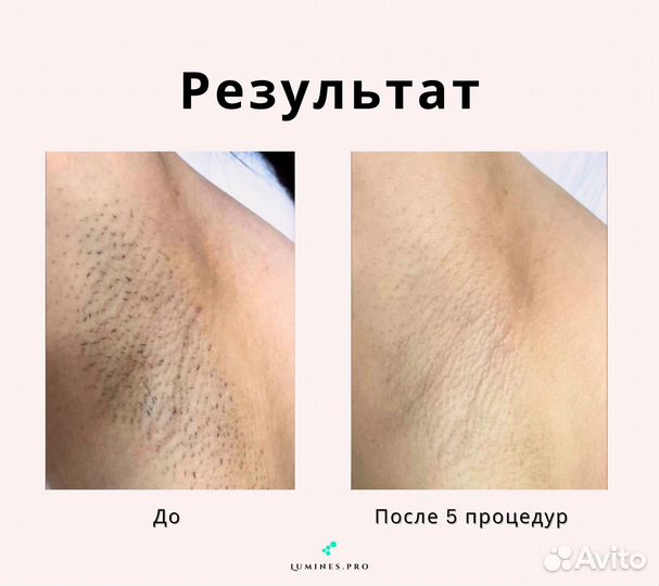 Диодный лазер для эпиляции Lumines’ максван 1200