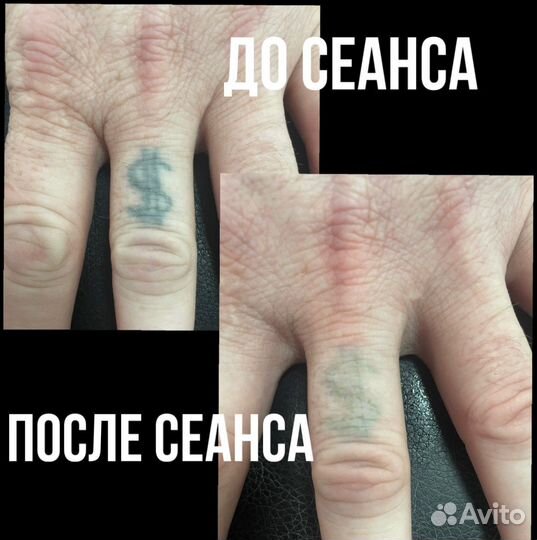 Удаления татуировок и татуажа