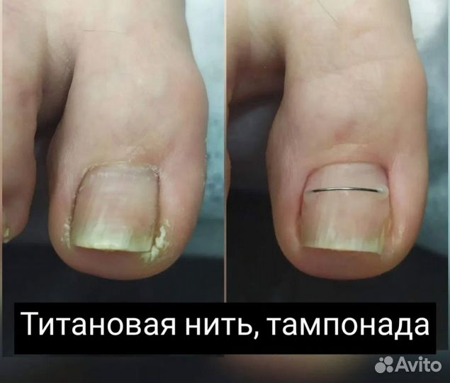 Педикюр парамедицинский, подолог