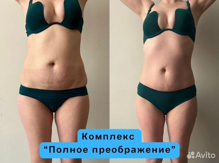 Коррекция фигуры / LPG массаж / Exilis
