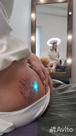 Удаление татуировок