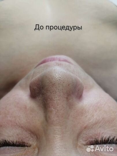 Чистка лица