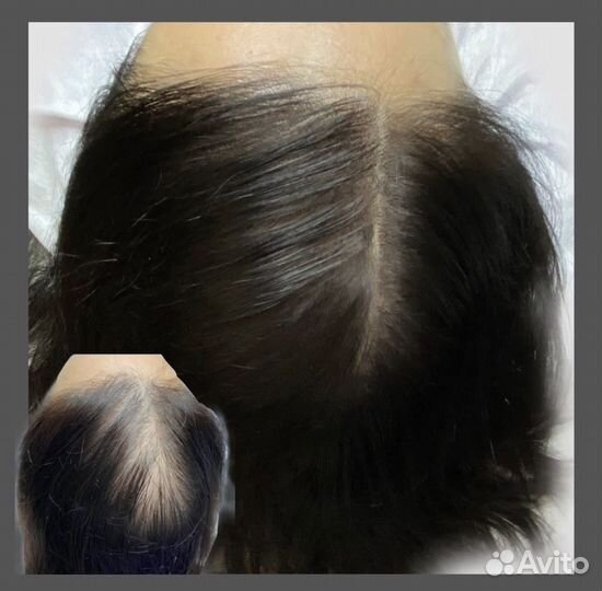 Трихопигментация женская