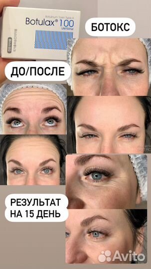 Модель на Увеличение губ. Ботокс. Пиллинг. Истра