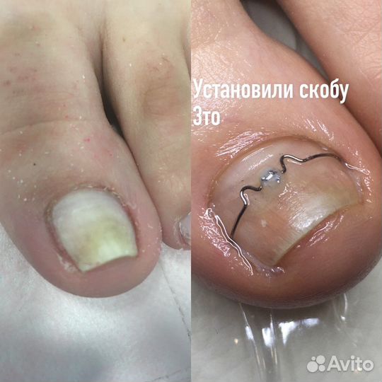 Педикюр подолог