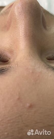 Уз чистка лица