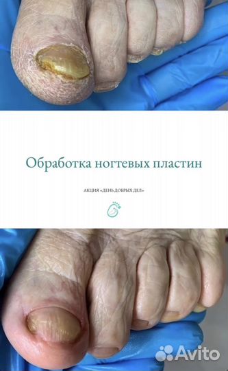 Педикюр для лежачих, уход за ногами на дому