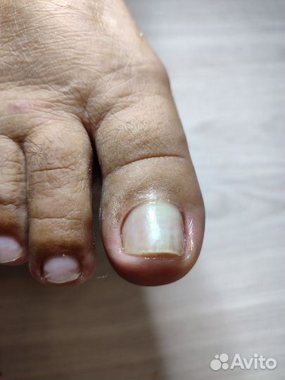 Медицинский педикюр с выездом на дом