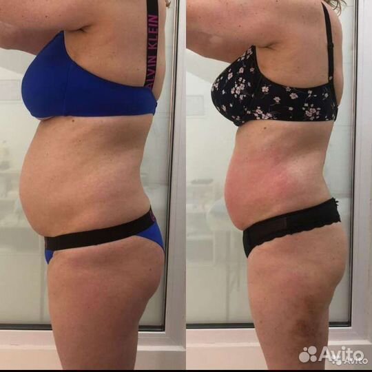 Аппаратная мезотерапия