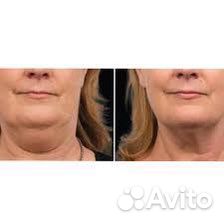 Криолиполиз подбородка
