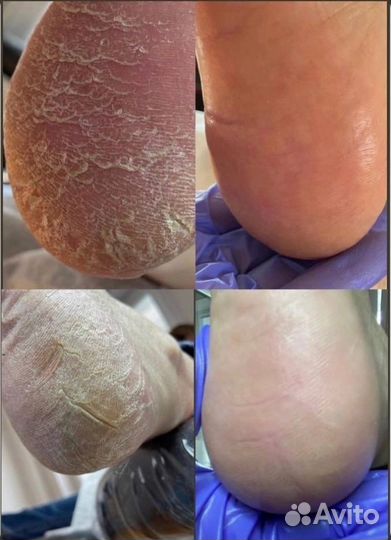 Препаратный педикюр kart