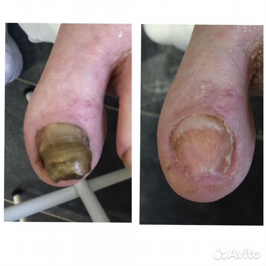 Медицинский педикюр. Подолог