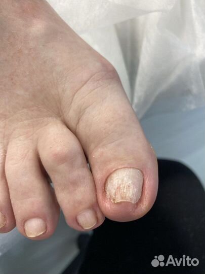 Педикюр подолог