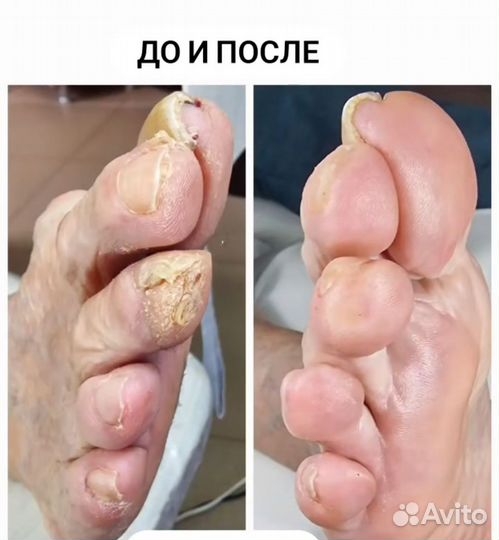 Педикюр на дому