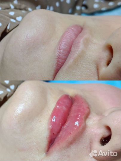 Биоревитализация